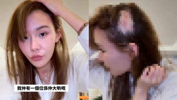 五索承認鬼剃頭「禿到唔會再有反應」情況惡化兩側寸草不生畫面觸目驚心