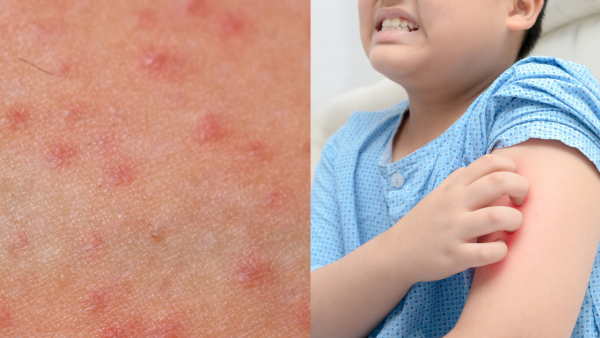 麻疹殺入香港機場！268人列密切接觸 病毒在空中可活2小時 可引發致命腦炎