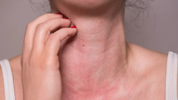 亂搽藥膏恐惡化！1招分辨熱痱/濕疹/過敏 專家揭3大致敏原附舒緩法