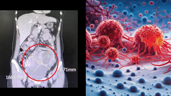44歲女肚脹無胃口揭患罕見雙癌！醫生拆解4大隱形婦科警號  附檢查貼士