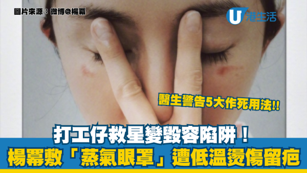 楊冪敷蒸氣眼罩慘遭燙傷險毀容！放鬆不成恐致盲兼留疤 醫生警告5大作死用法：戴住Con敷極危險！