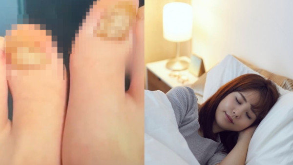 著襪瞓覺出事！腳趾慘變恐怖千層酥 醫生警告非灰甲只能拔除