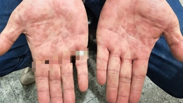 露營惹性病？男手掌生紅斑以為蟲咬 醫揭竟染二期梅毒附3大特徵