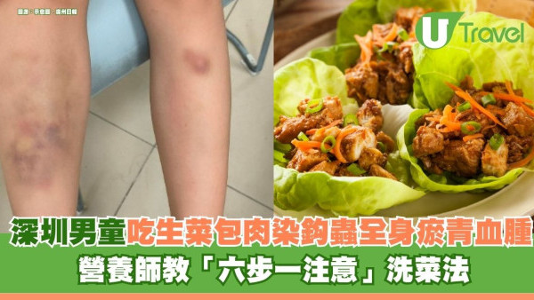 深圳6歲男童吃生菜包肉染鈎蟲 全身瘀青血腫需食驅蟲藥 營養師教「六步一注意」洗菜法