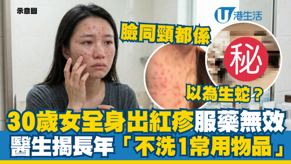 以為生蛇？30歲女全身出紅疹服藥無效 醫生揭長年「不洗1日常用品」令超級細菌入血