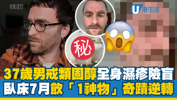 濕疹停用類固醇險盲！37歲男全身爛肉臥床7個月 靠飲「1神物」奇蹟逆轉爛面