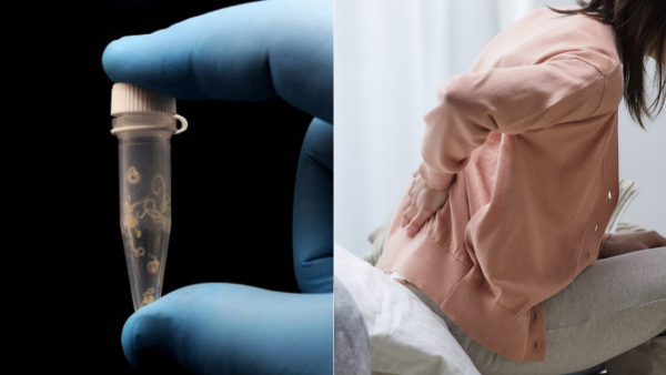 以為普通腰痛？57歲婦險癱瘓 開刀驚揭逾千條寄生蟲藏脊髓！醫生警告2大惡習