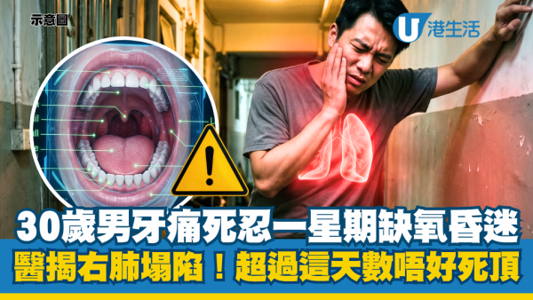 30歲男牙痛一星期缺氧昏迷險死！醫生揭右肺完全塌陷積膿：超過這天數唔好死頂