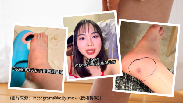 抓破蚊爛隨時喪命？港女染蜂窩組織炎行唔到 醫生揭2類人極高危促即求醫