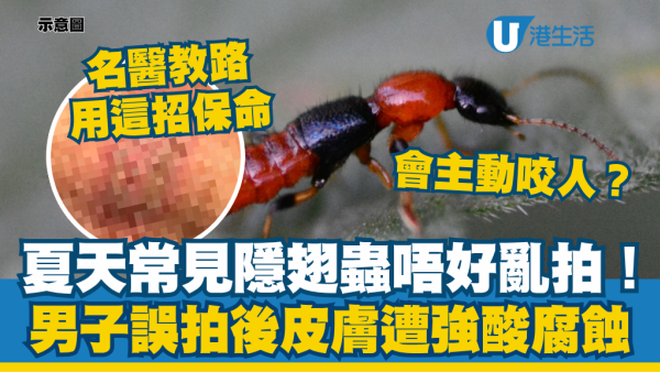 夏天常见隐翅虫别乱拍！男子误拍后皮肤遭强酸腐蚀 名医教路用这招保命