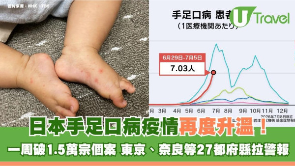 日本手足口病疫情再度升溫！一周破1.5萬宗個案 東京、奈良等27都府縣拉警報