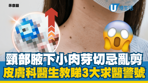頸部腋下小肉芽切忌亂剪！皮膚科醫生教睇3大求醫警號：恐是慢性病預兆隱患