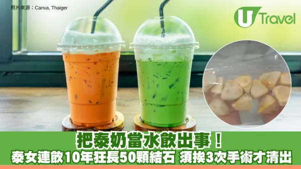把泰奶當水飲出事！女子連飲10年狂長50顆結石 須接受3次手術才清出