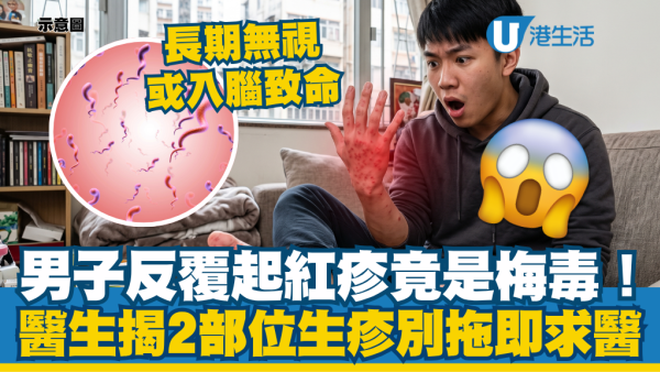 男子反覆起紅疹竟是二期梅毒！醫生揭2部位長疹最關鍵：長期無視或入腦致命