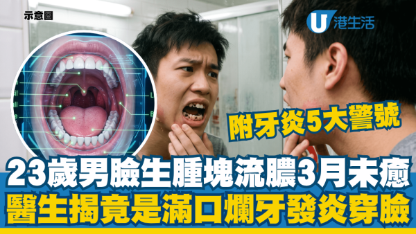23歲男無視蛀牙搞到狂生暗瘡！醫生揭口腔發炎恐怖後果：出現這5徵兆速驗牙
