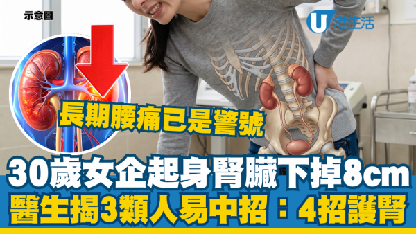 30岁女起立肾脏竟往下掉8cm！医生警告“3类人”易中招：长期腰痛已是警号