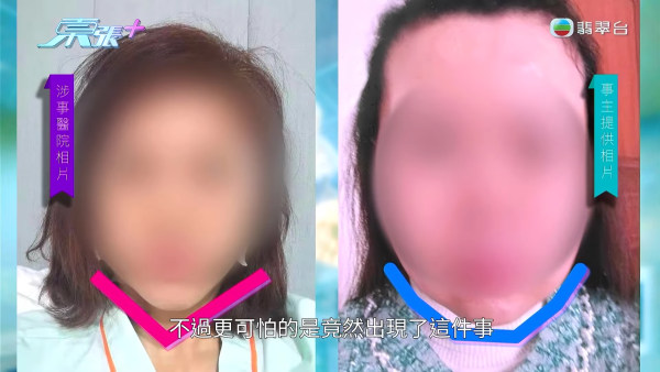 港女赴深圳拉皮惨变毁容级包包面！恐怖疤痕增生兼狂掉头发 涉假病历院长嚣张寸爆