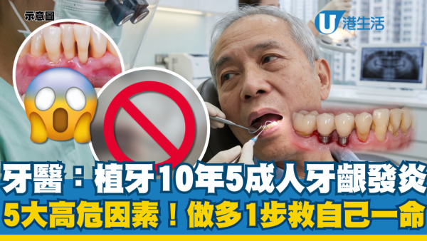 植牙10年5成人牙齦發炎！牙醫點名5大高危因素：做多這1步救自己一命