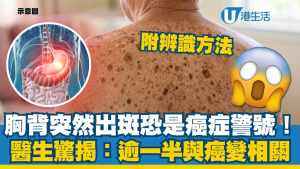 胸背突然出斑恐是癌症警號！醫生驚揭半年爆發成片斑：逾一半與癌變相關