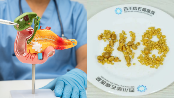 26歲打工仔生248粒膽結石！劇痛送院膽囊被塞爆／醫嘆1飲食惡習血脂超標逾5倍