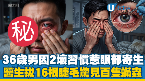眼睛干痒滴眼药水都没用！36岁男睫毛惊见螨虫大军：揭元凶是“这坏习惯”