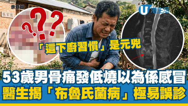 53岁男骨痛低烧以为是感冒！医揭“布鲁氏菌病”极易误诊：“这个下厨习惯”是元凶