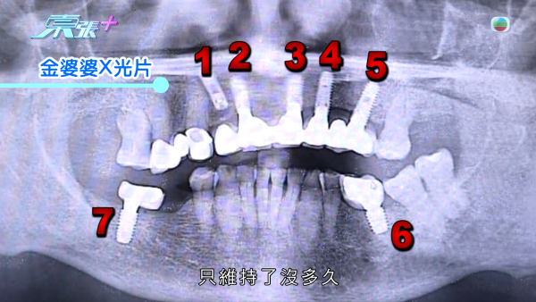 柴灣街坊集體指控牙醫醫療失當！15萬植牙慘變「大海撈針」 4.5萬全口箍牙竟越箍越疏 