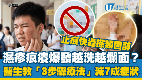 湿疹爆发越洗越烂脸？皮肤科医生教“3步骤疗法”减7成症状：止痒快过类固醇
