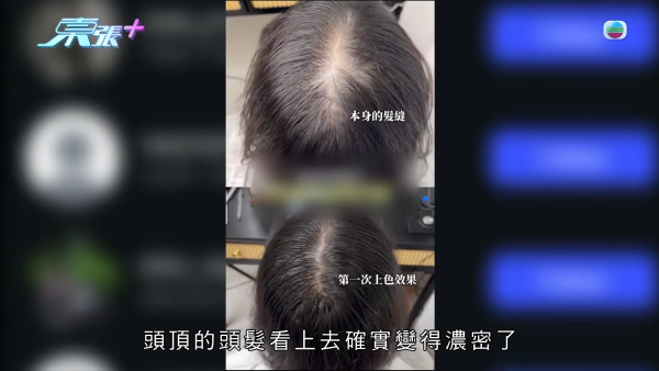 港女17岁起脱发受尽折磨！4000元再生纹发惊变烂头皮触目惊心 揭美容院颜料疑似淘宝同款