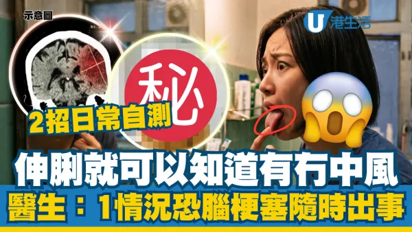 伸脷可檢查中風先兆！醫生揭「FAST自測法」對鏡做一動作：發現異常即時求醫