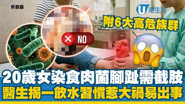 20歲女染食肉菌腳趾截肢！醫生揭一飲水習慣惹大禍：6大高危族群易出事