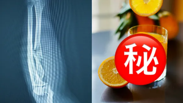 專家列3高危飲品可致骨折風險飆4.7倍！這款常見早餐同是幫兇／養成3良好習慣助力挽狂瀾