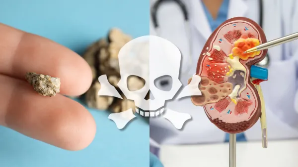 30歲男結石康復不足兩年又復發！半夜劇痛血尿輸尿管塞死入院／醫生： 復發率高達75%