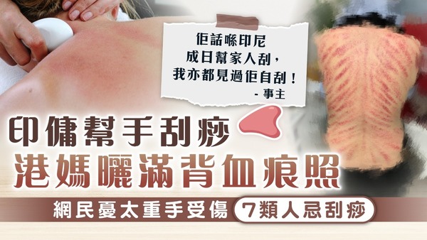 刮痧療法｜印傭幫手刮痧 港媽曬滿背血痕照 網民憂太重手受傷【7類人忌刮痧】