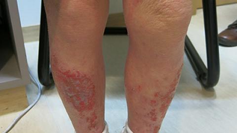 解構濕疹2大成因 皮膚專科醫生教你預防+治療方法