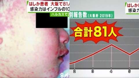 日本麻疹感染人數急升 大阪府患者數目為去年總數5倍