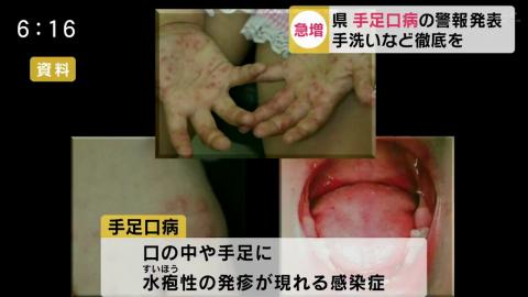 日本多地爆發手足口病 大阪、九州多縣患者人數超越警戒級別