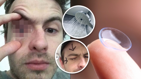 英國男未除隱形眼鏡洗澡惹寄生蟲 寄生蟲鑽入角膜一度失明！