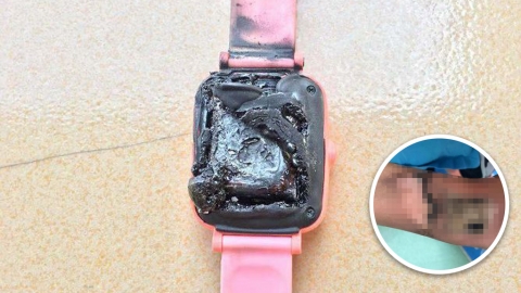 兒童智能手錶發生自燃個案 突飆高溫燙傷手腕！