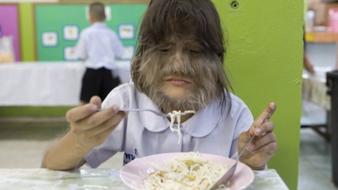 泰女患罕見疾病變「長毛狼女」 剃去毛髮現真身判若2人