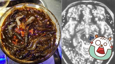 內地男長期頭痛驚驗出腦內寄生蟲多如「芝麻餅」 揭因吃一類食品成恐怖傳染途徑