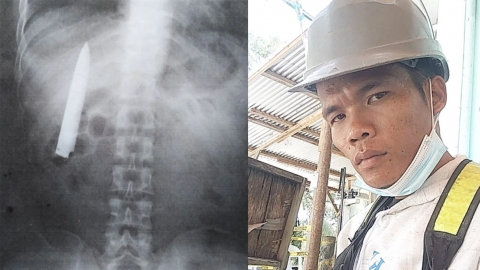 菲男不知胸口藏刀長達14個月